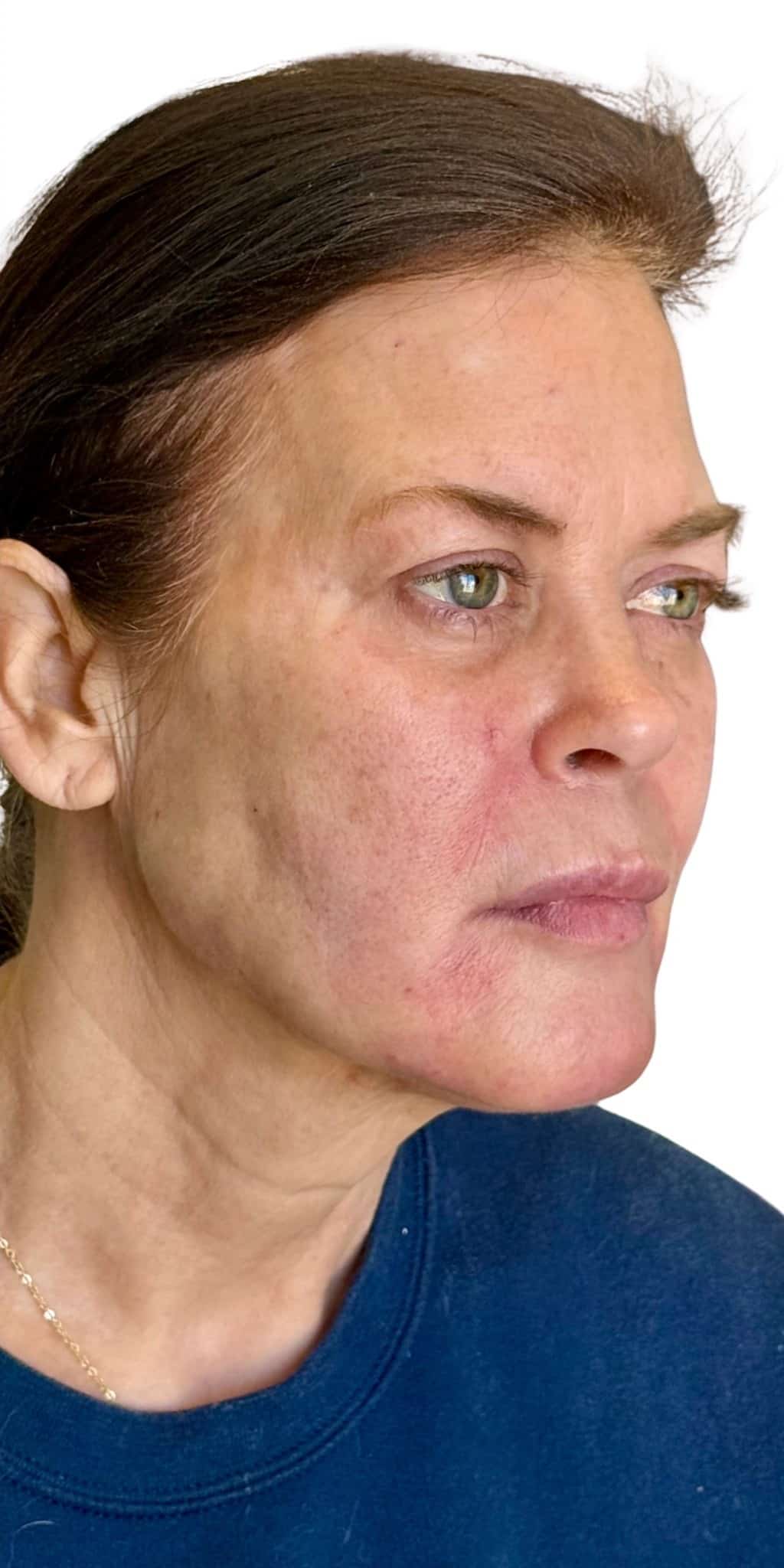 After Image: Facial Rejuvenation with Radiesse