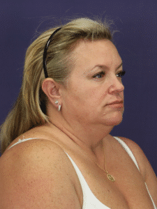 Before Image: Deep Plane Face & Neck Lift & Lower blepharoplasty