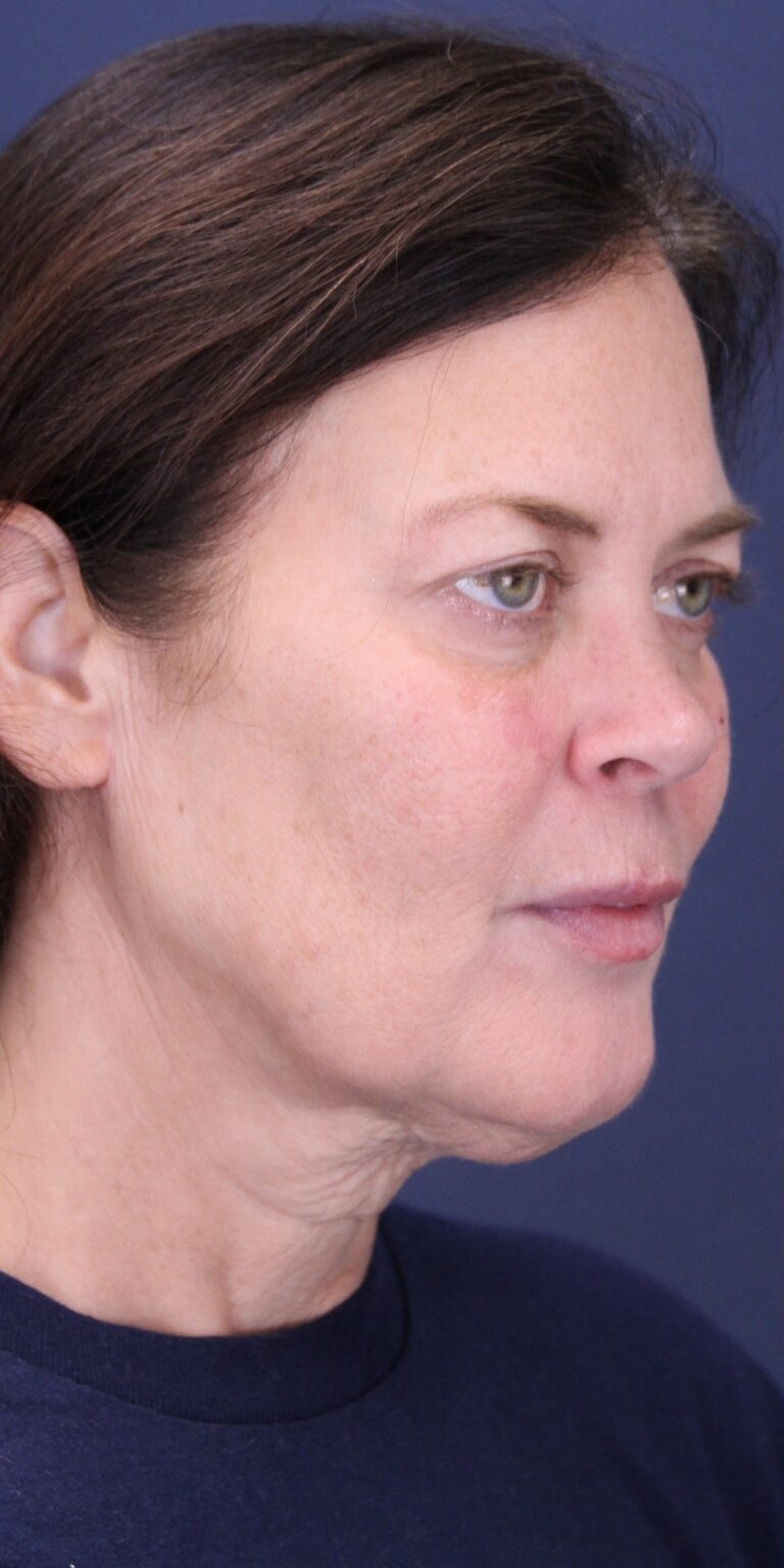 Before Image: Facial balancing - right-front-oblique