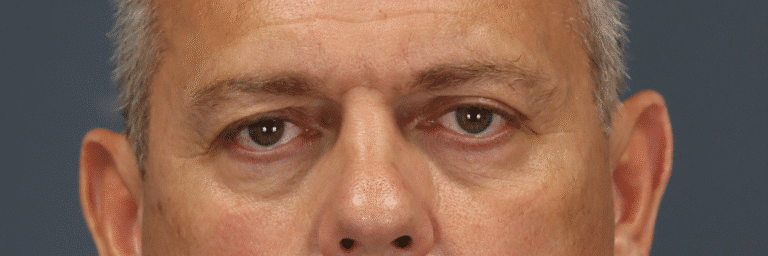 Before Image: Endoscopic Brow lift, Upper & Lower Eyelid Lift, Fat grafting, Fat repositioning & Under Eye Laser - front