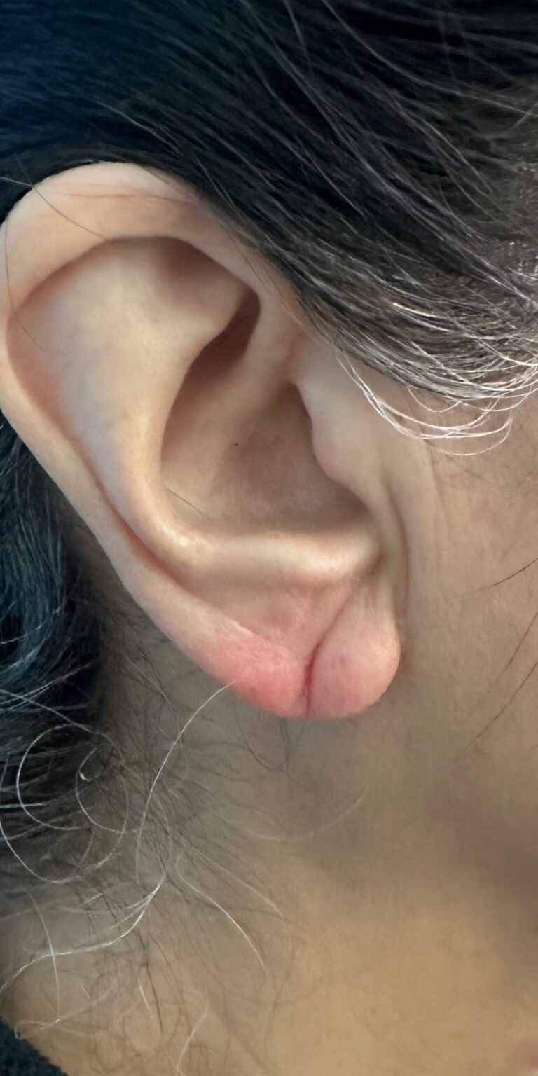 Before Image: Earlobe repair - front