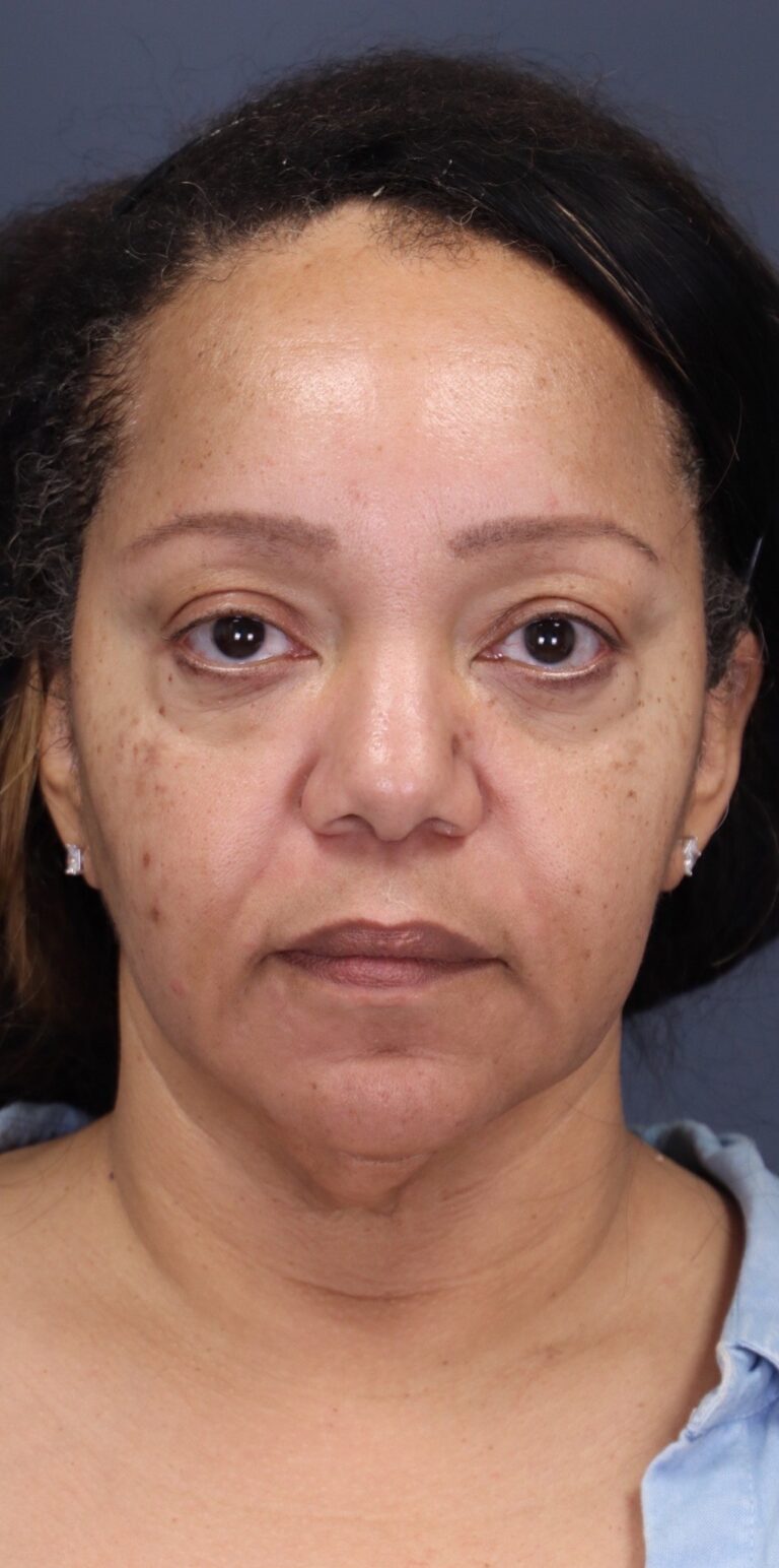 Before Image: Facial Balancing with Filler - front
