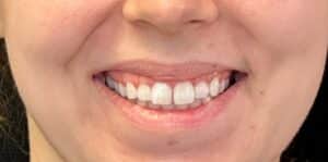 Before Image: Toxin Cosmetic