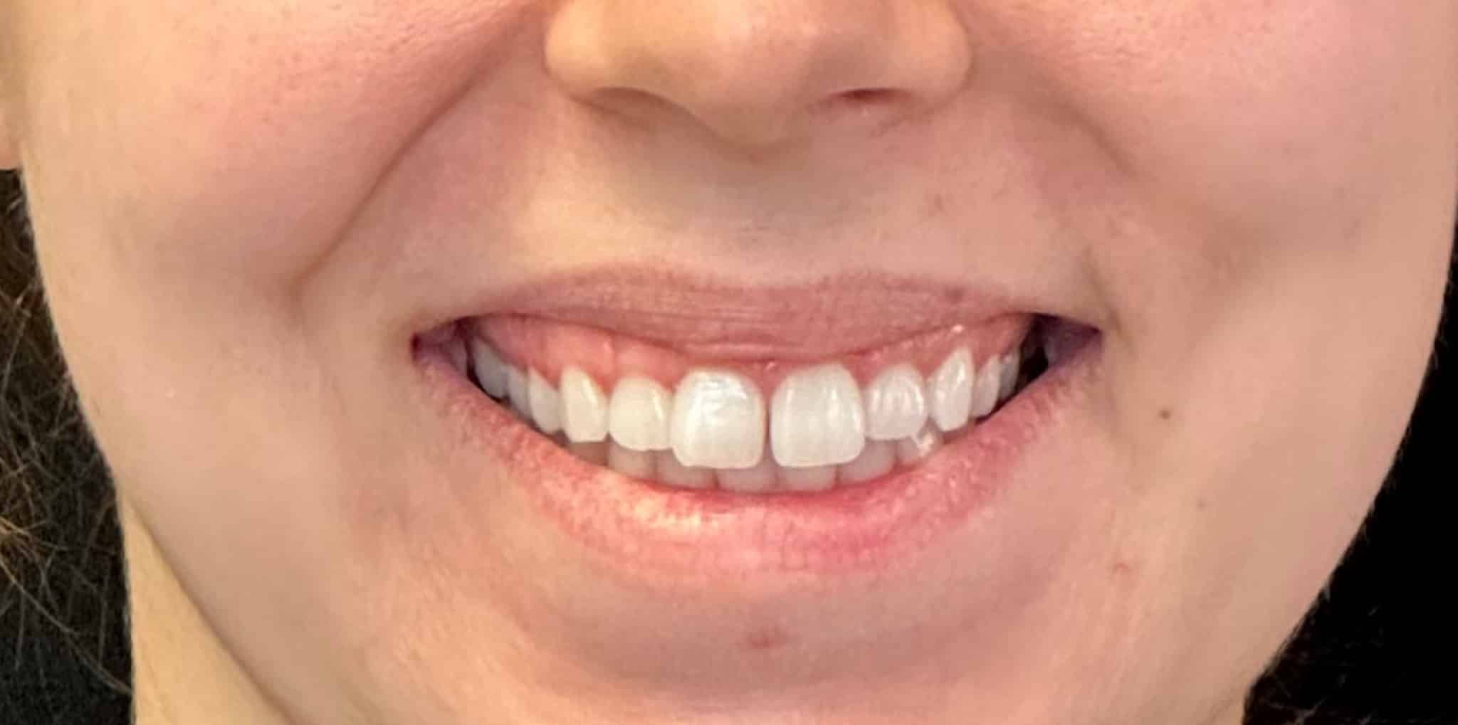 Before Image: Toxin for Gummy Smile - front
