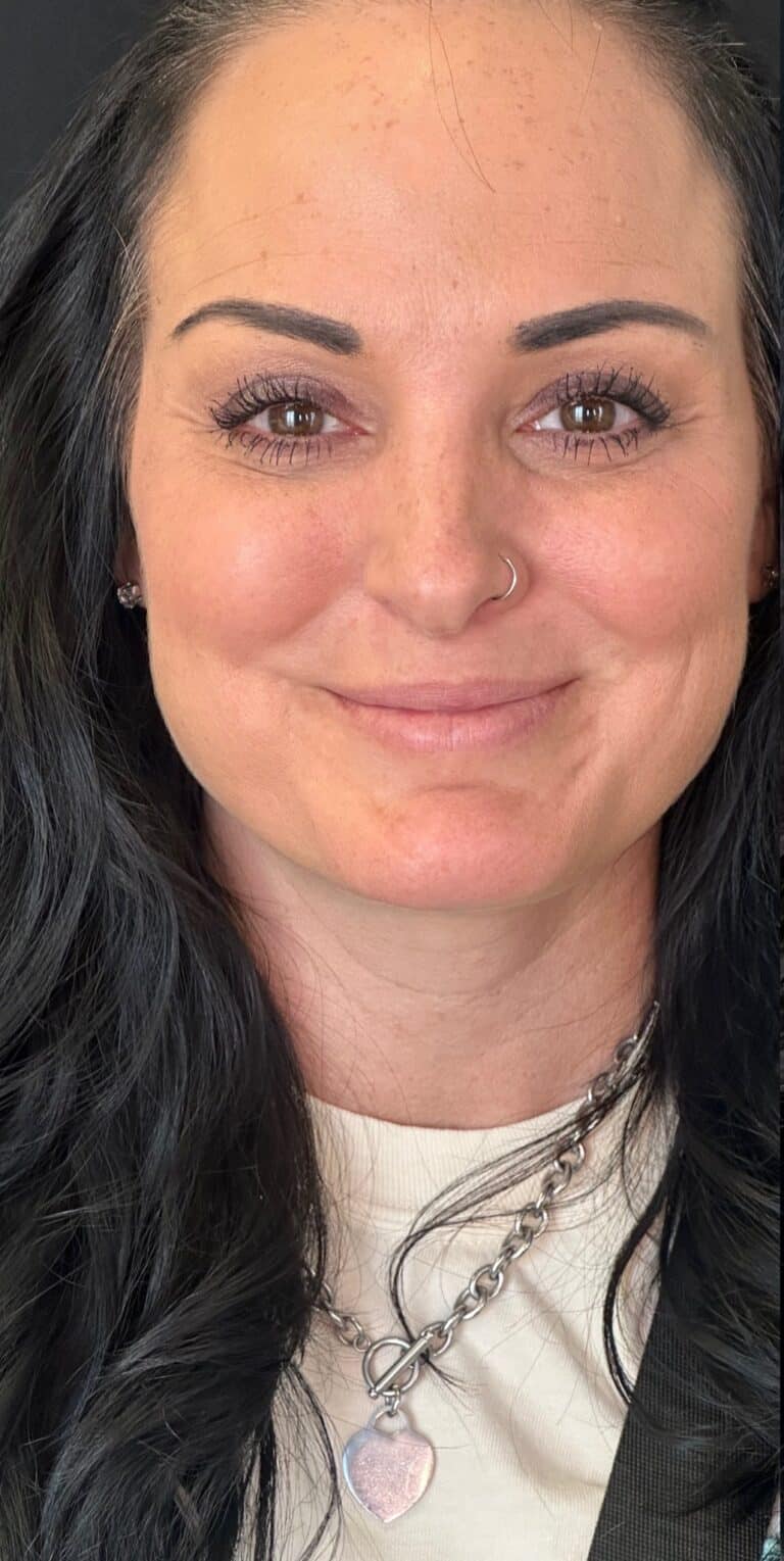 Before Image: Lip Filler By Dr. Costeloe - front