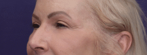 After Image: Upper eyelid lift, facial fat grafting, peri ocular deep resurfacing