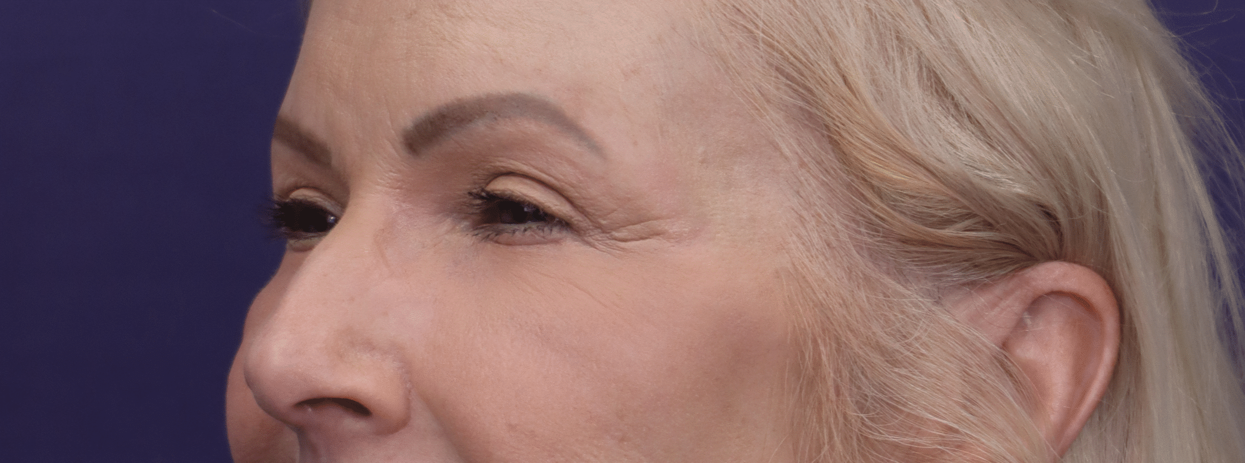 After Image: Upper Eyelid Lift, Facial Fat Grafting and Lower Lid Laser - left-side