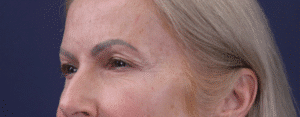 Before Image: Upper eyelid lift, facial fat grafting, peri ocular deep resurfacing