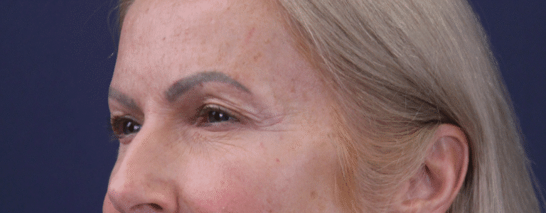 Before Image: Upper eyelid lift, facial fat grafting, peri ocular deep resurfacing - left-side