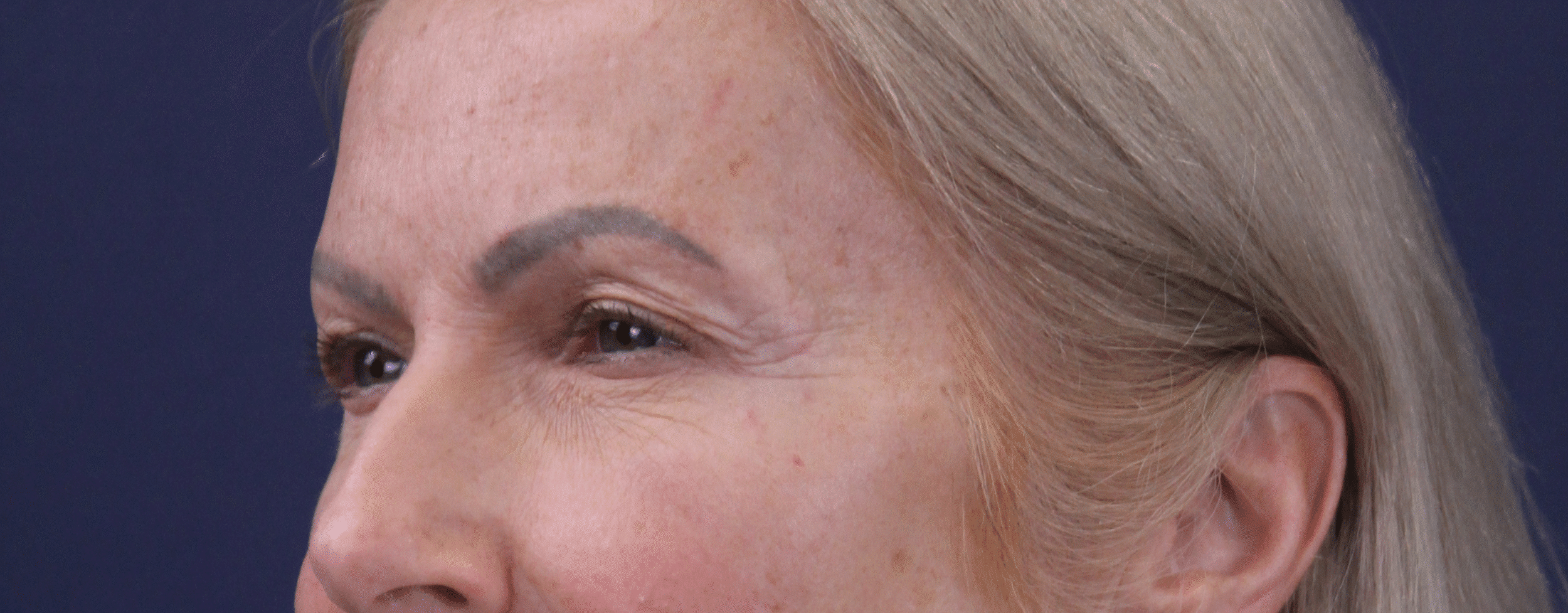 Before Image: Upper Eyelid Lift, Facial Fat Grafting and Lower Lid Laser - left-side