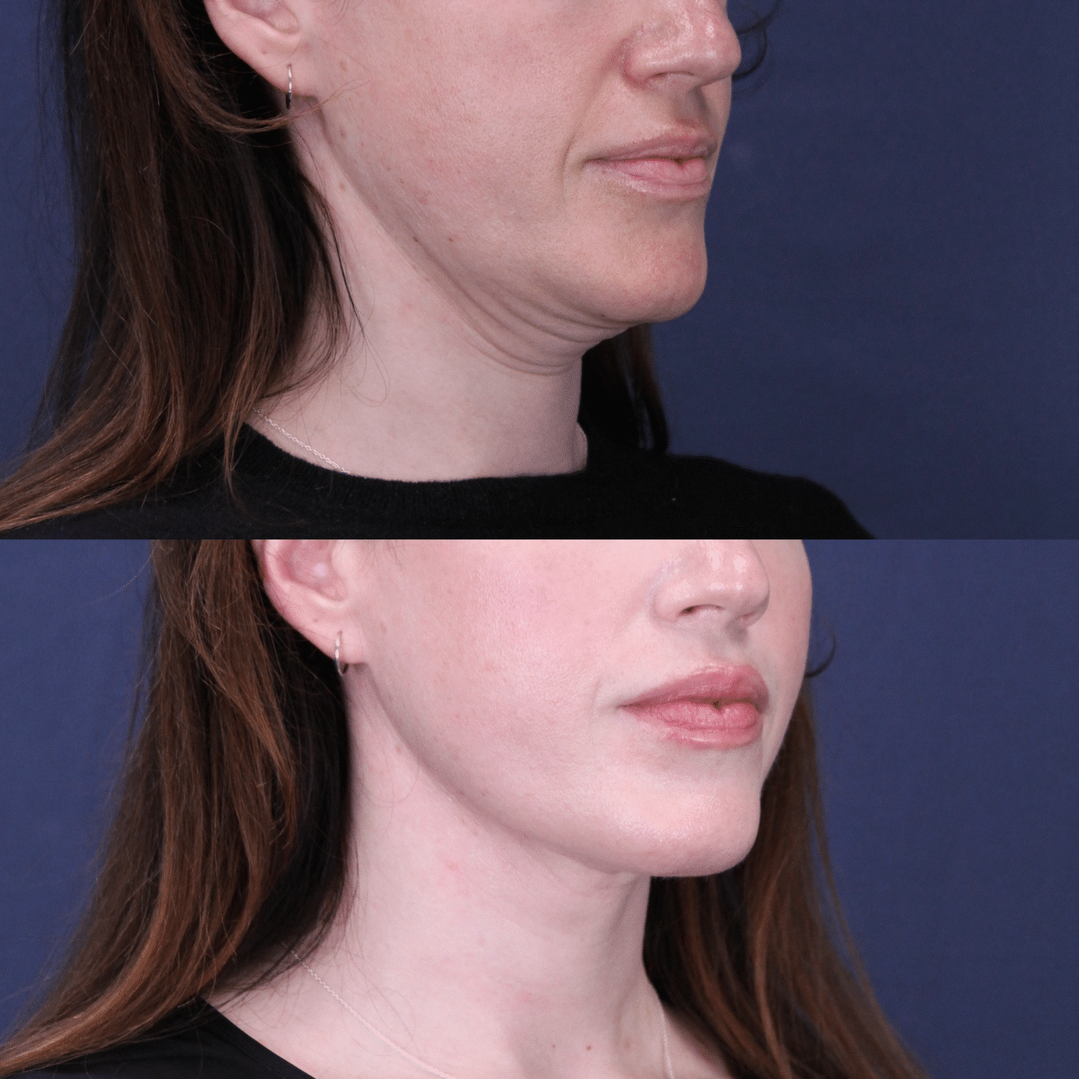 Case10 angle right neck