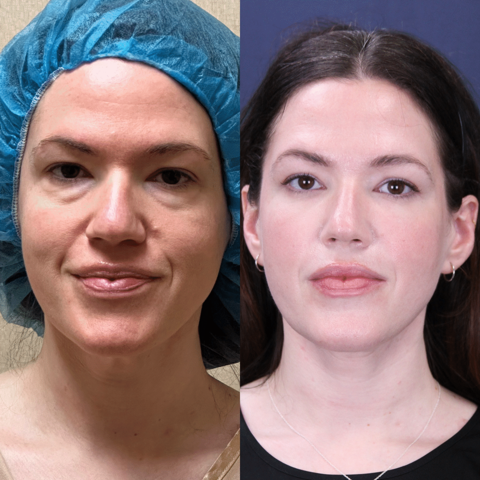 Case10 front looking