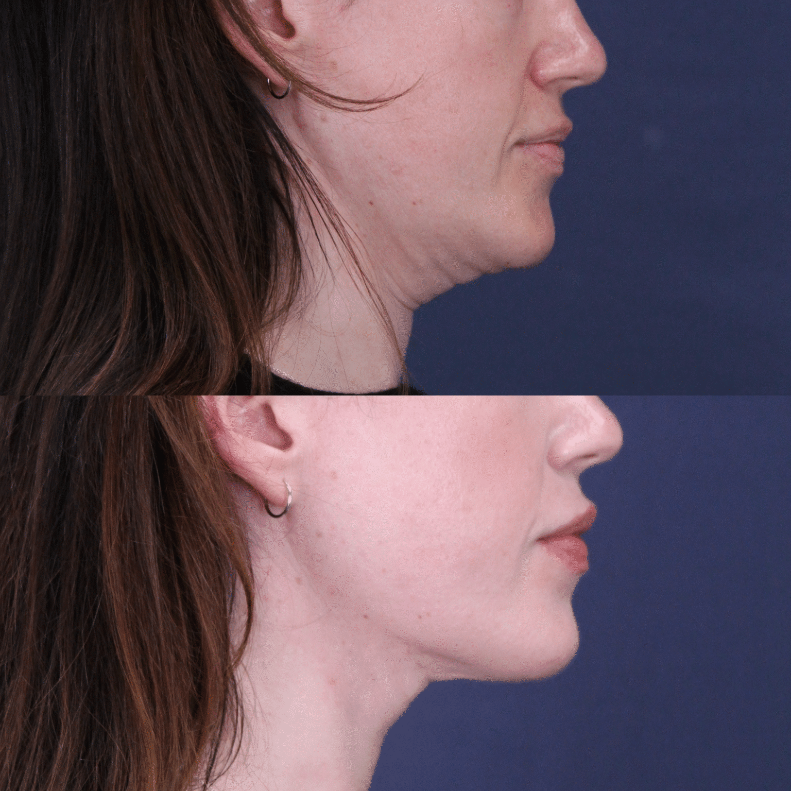 Case10 right side neck