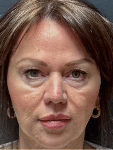 Before Image: Upper and Lower Eyelid Lift, Lower Eyelid Profractional Laser