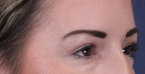 After Image: Upper Blepharoplasty