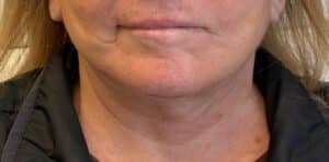 After Image: Deep plane neck and facelift