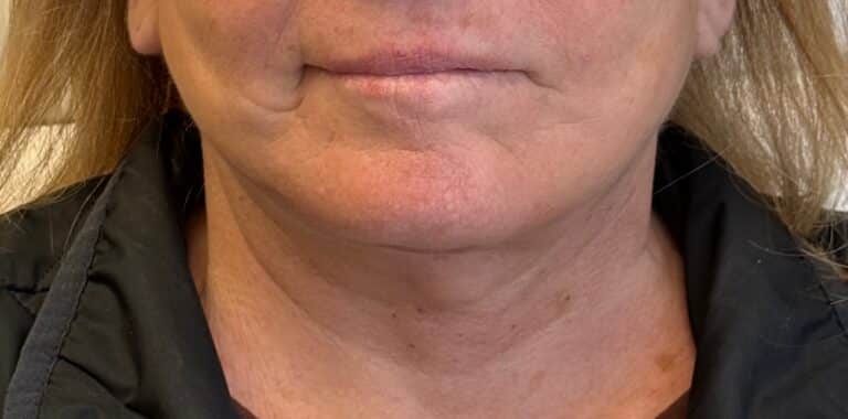 After Image: Deep plane neck and facelift - front