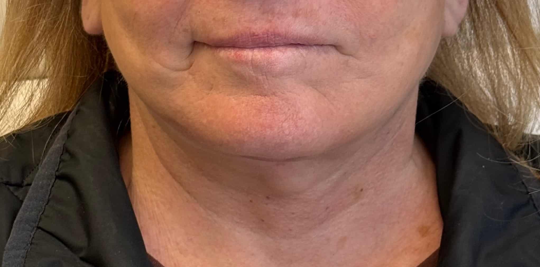 After Image: Face and Neck Lift - front