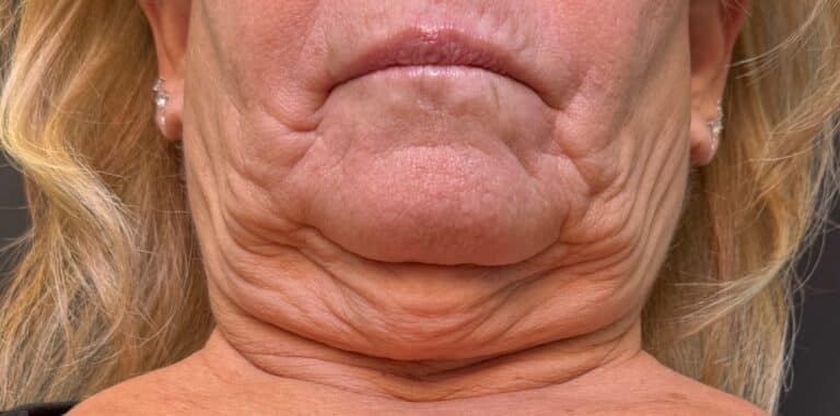Before Image: Deep plane neck and facelift - front