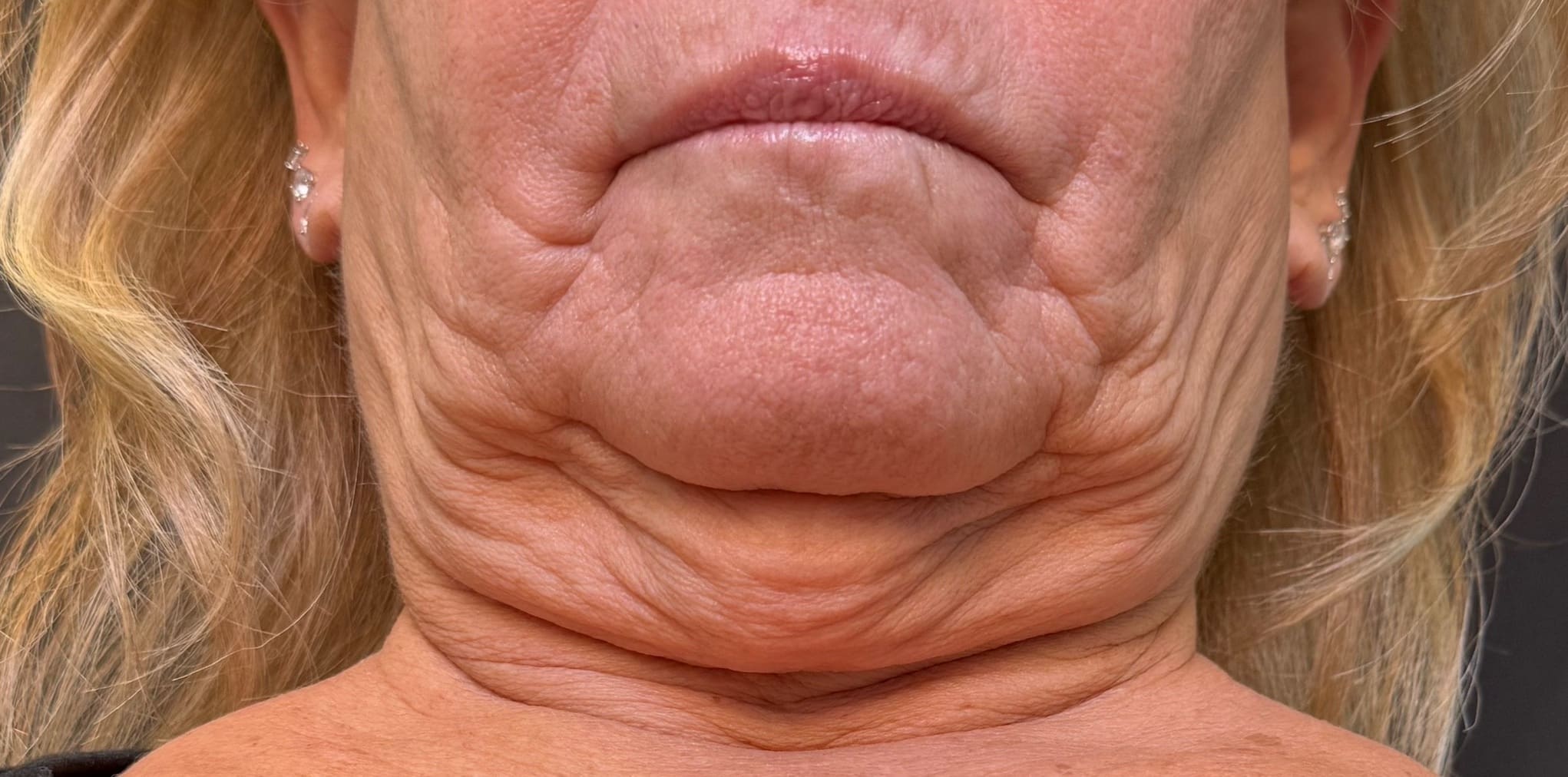 Before Image: Face and Neck Lift - front