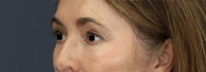 After Image: Endoscopic Brow lift, Upper & Lower Eyelid Lift, Fat grafting & Under Eye Laser