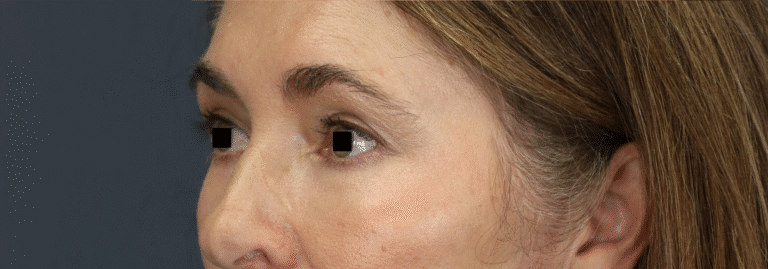 After Image: Endoscopic Brow lift, Upper & Lower Eyelid Lift, Fat grafting & Under Eye Laser - front