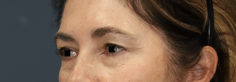 Before Image: Endoscopic Brow lift, Upper & Lower Eyelid Lift, Fat grafting & Under Eye Laser - front