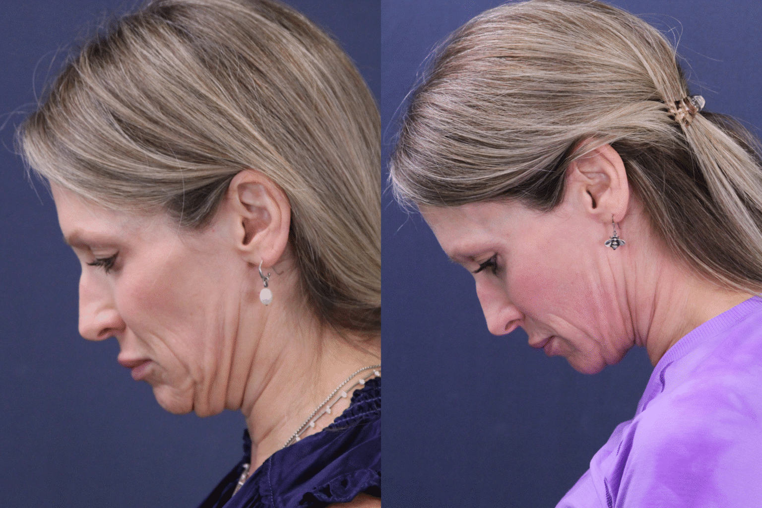 MyEllevate JM left tilt