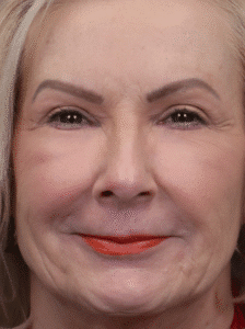 After Image: Upper Eyelid Lift & Lower Lid Laser Resurfacing