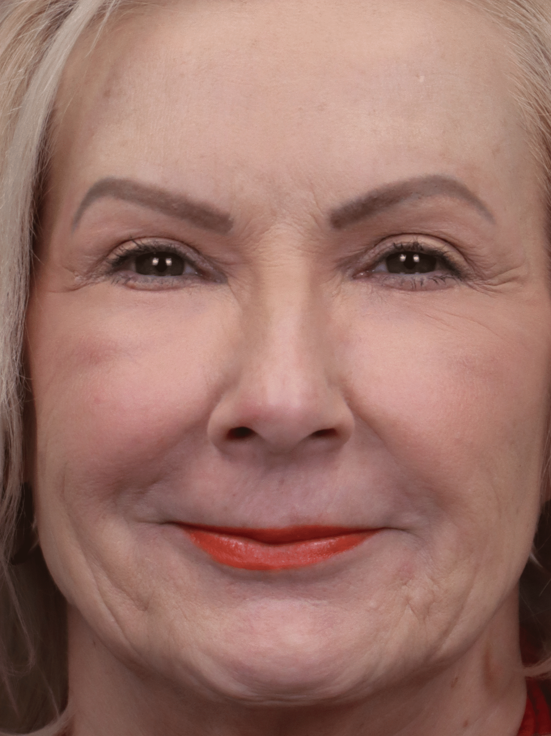After Image: Facial Fat Grafting - front