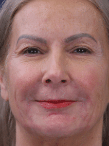 Before Image: Upper Eyelid Lift & Lower Lid Laser Resurfacing