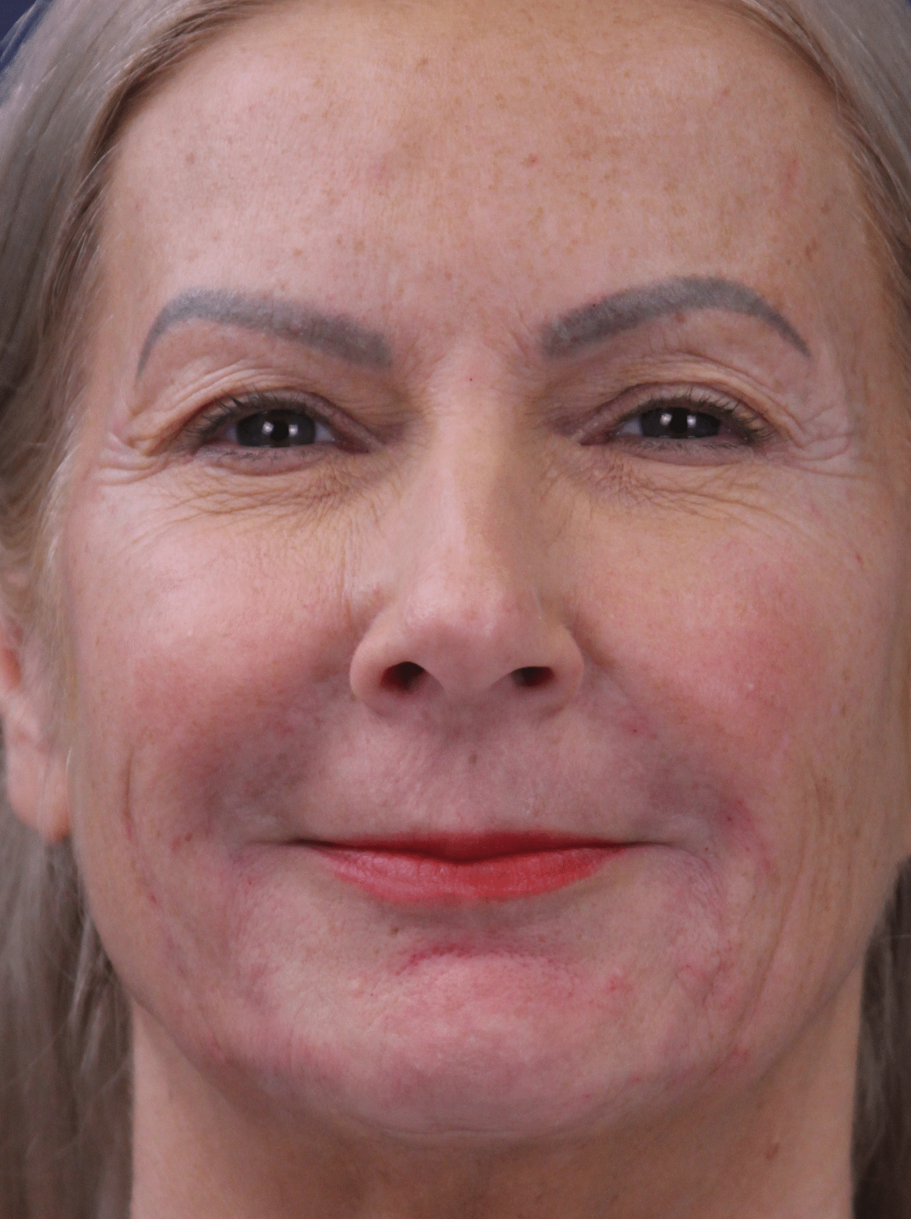 Before Image: Facial Fat Grafting - front
