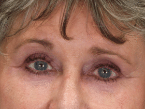 After Image: Upper & Lower Eyelid Lift, Fat Grafting & Under Eye Laser