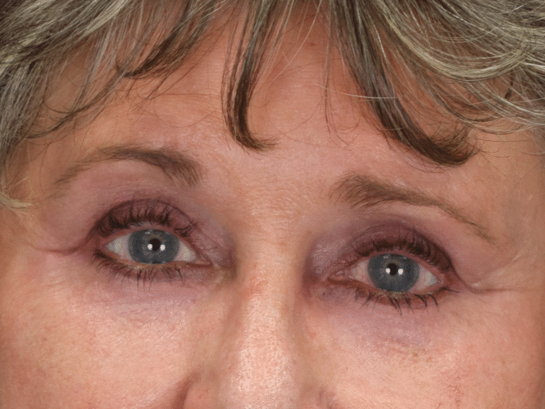 After Image: Upper & Lower Eyelid Lift, Fat Grafting & Under Eye Laser - front
