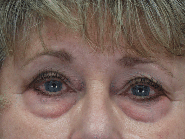 Before Image: Upper & Lower Eyelid Lift, Fat Grafting & Under Eye Laser - front
