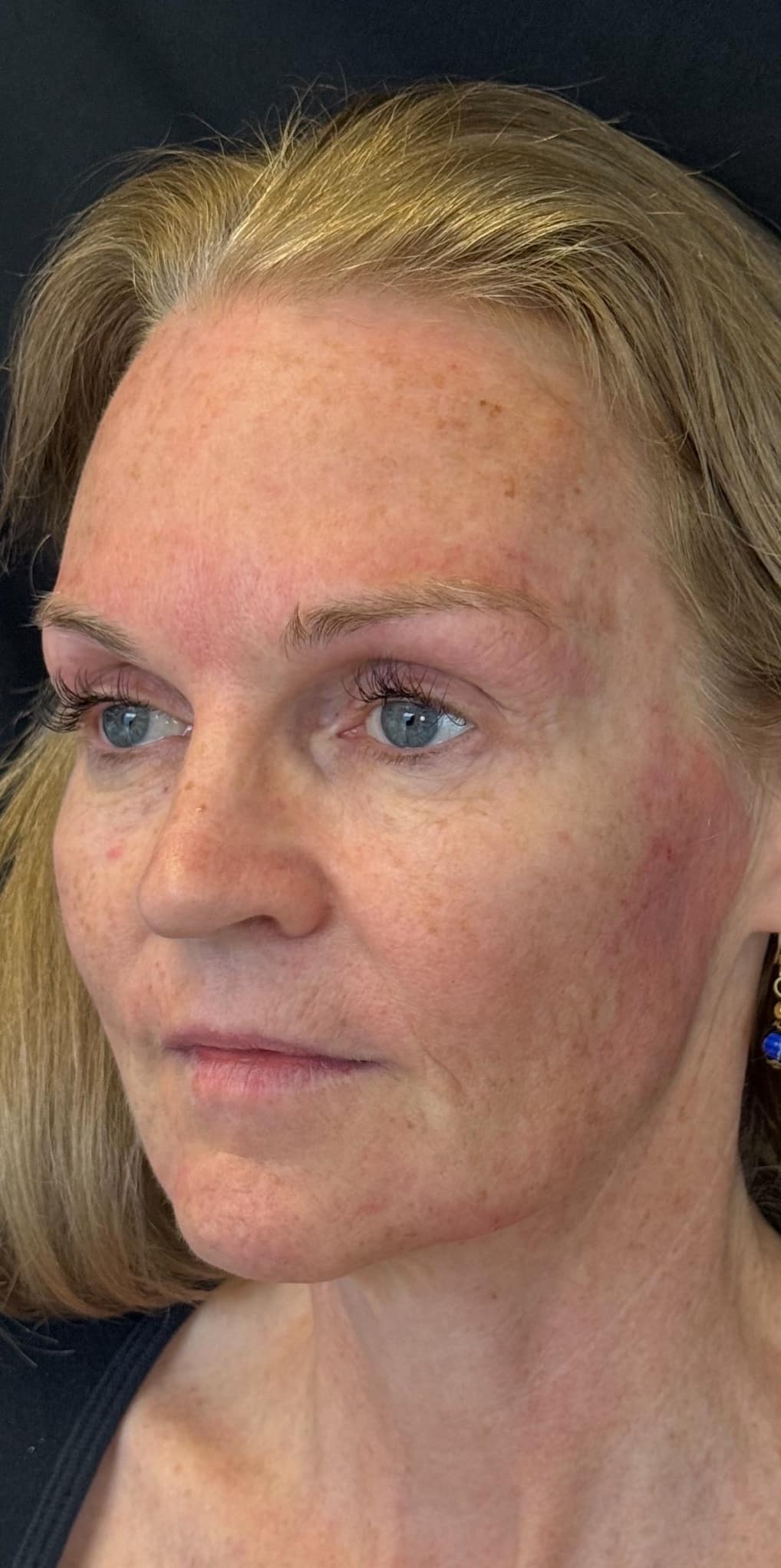 After Image: Facial Rejuvenation with Renuva - left-back-oblique