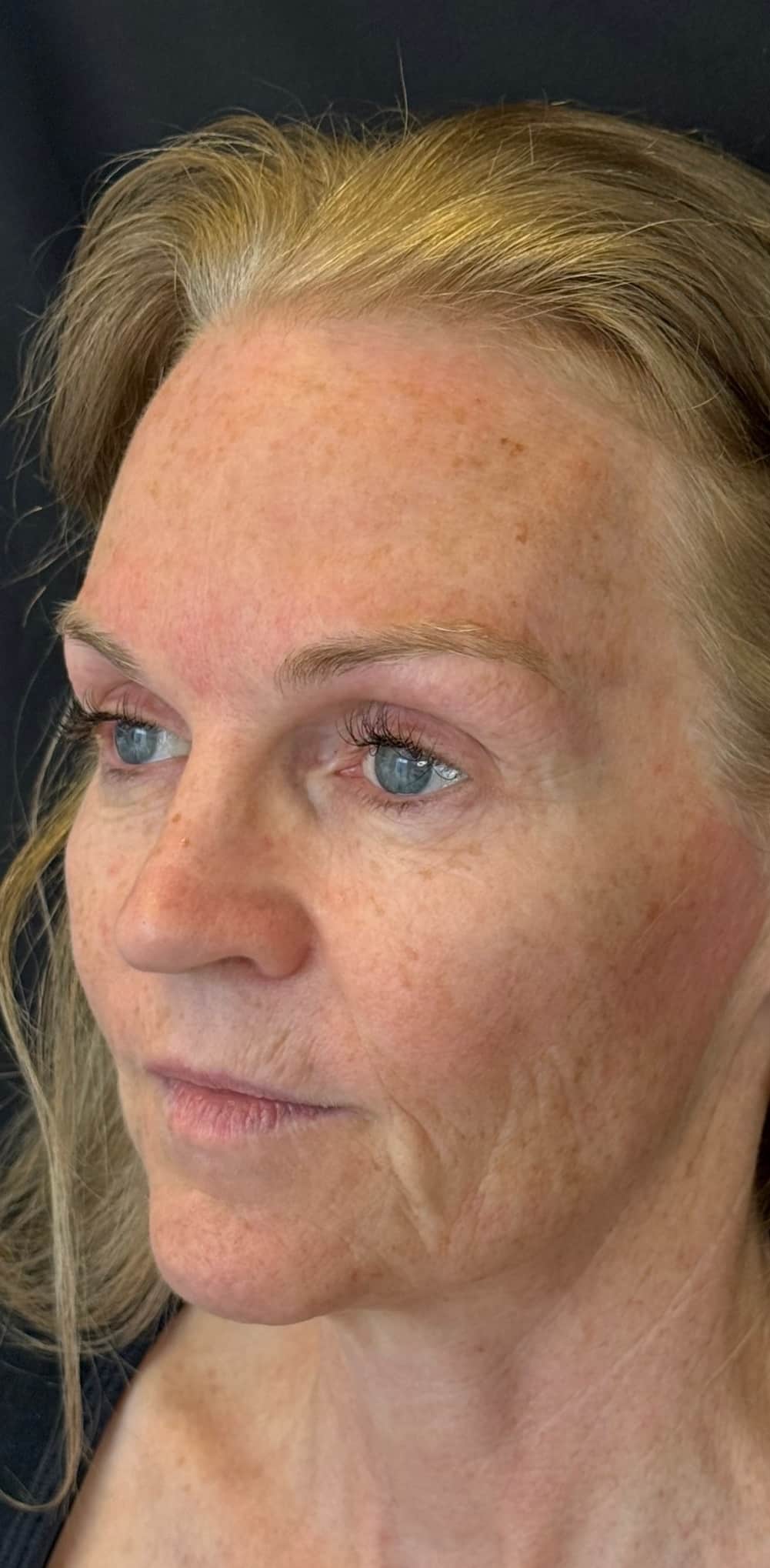 Before Image: Facial Rejuvenation with Renuva - left-back-oblique
