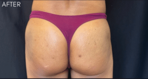After Image: Injectable Butt Lift