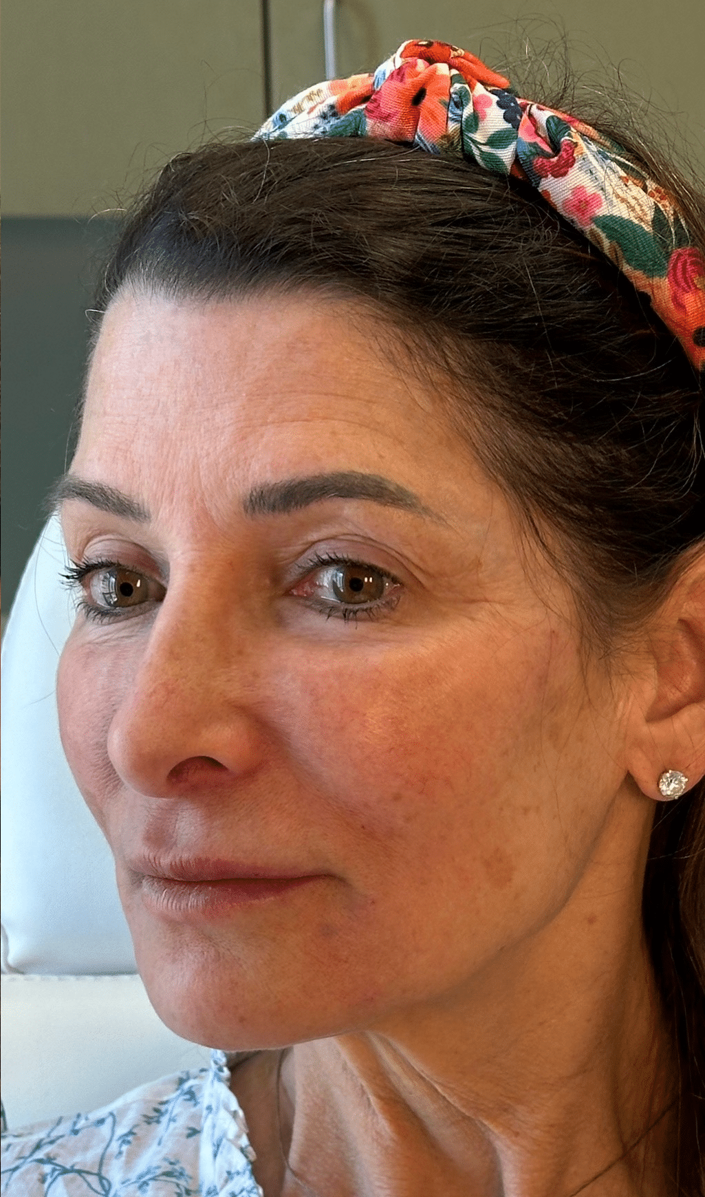 After Image: Facial Balancing with Filler - left-front-oblique