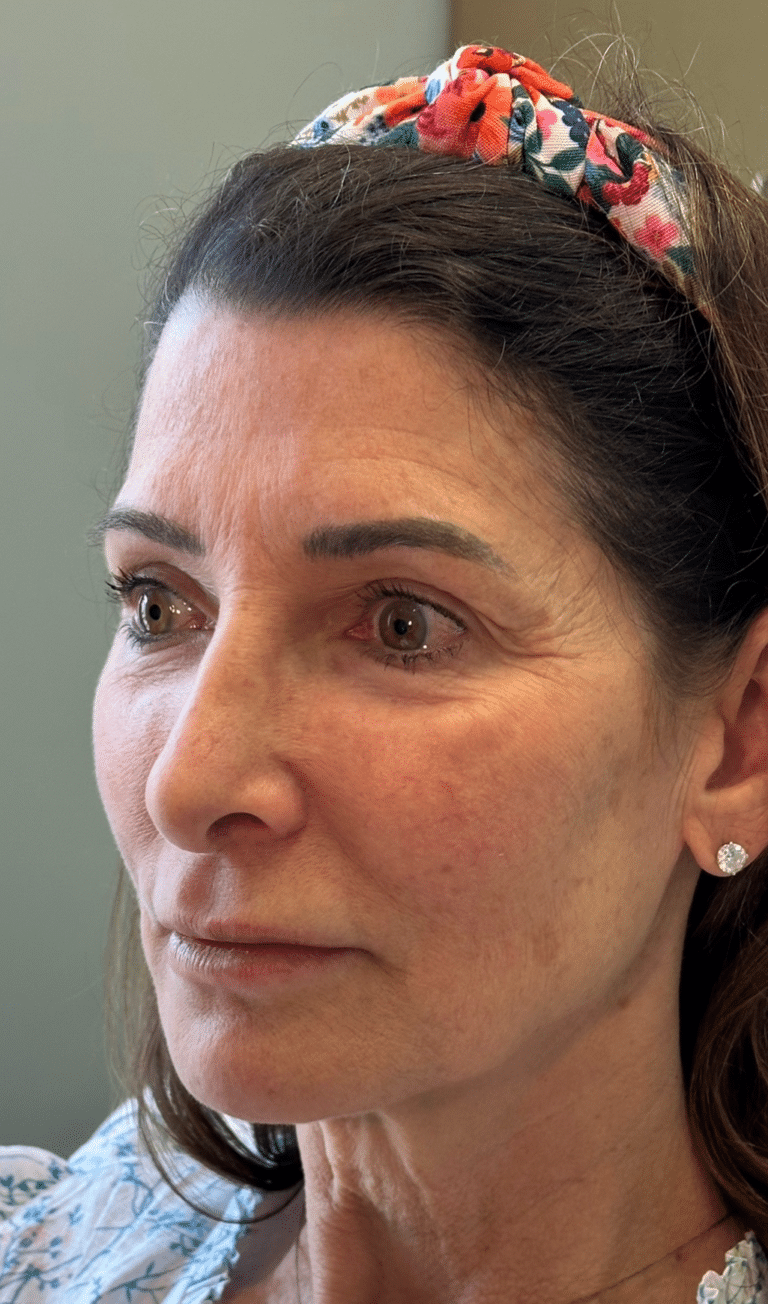 Before Image: Facial Balancing with Filler - left-front-oblique