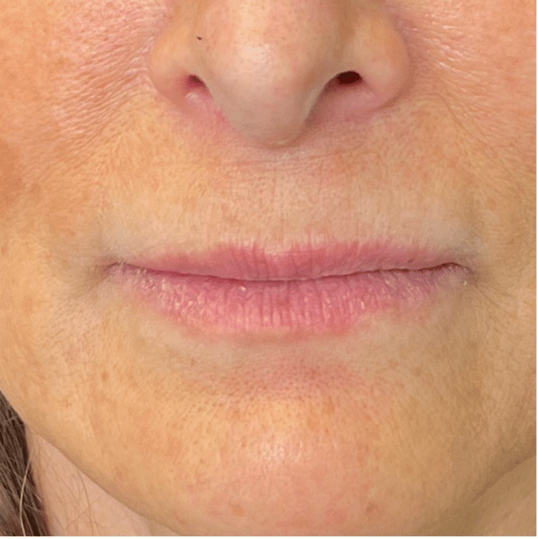 Before Image: Lip Filler - front