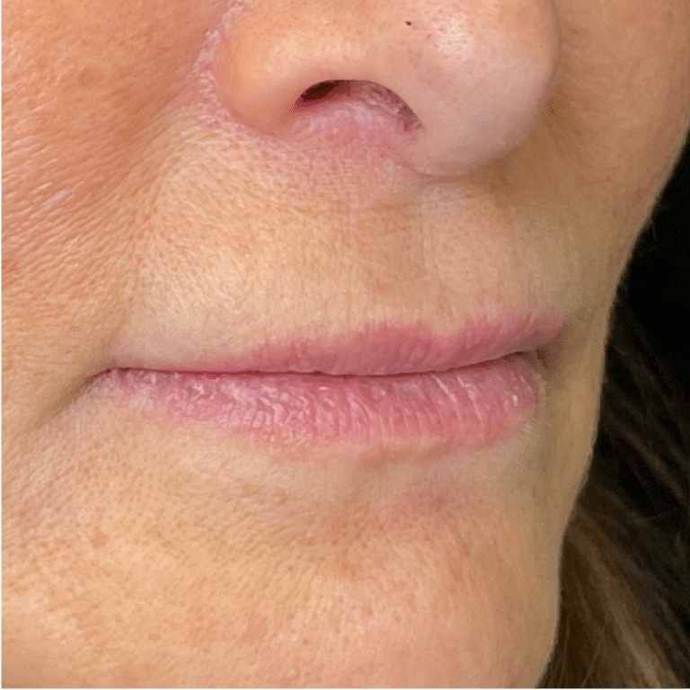 Before Image: Lip Filler - right-front-oblique