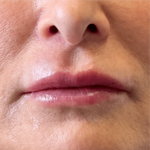 After Image: Lip Filler