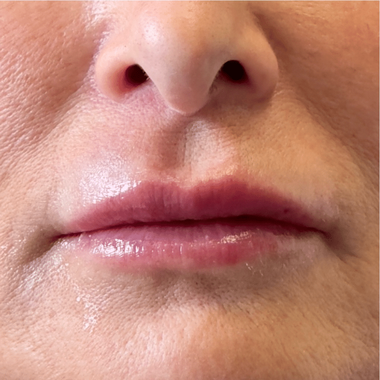 After Image: Lip Filler - front
