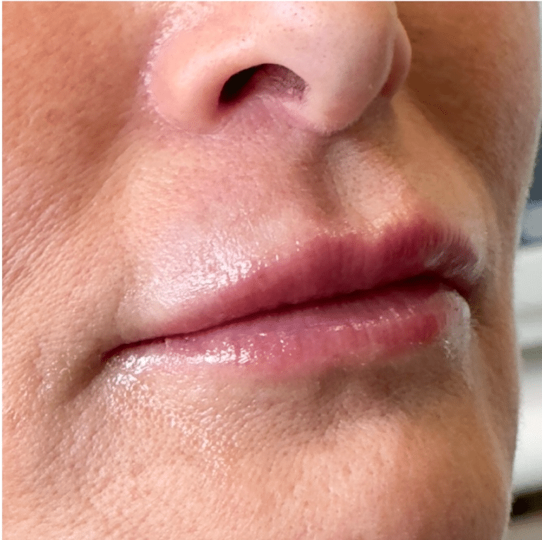 After Image: Lip Filler - right-front-oblique