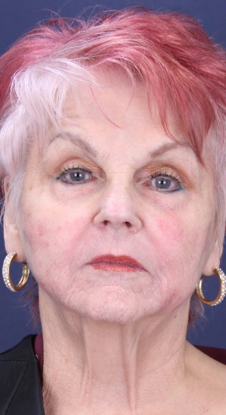 After Image: Facial Rejuvenation with Radiesse - front