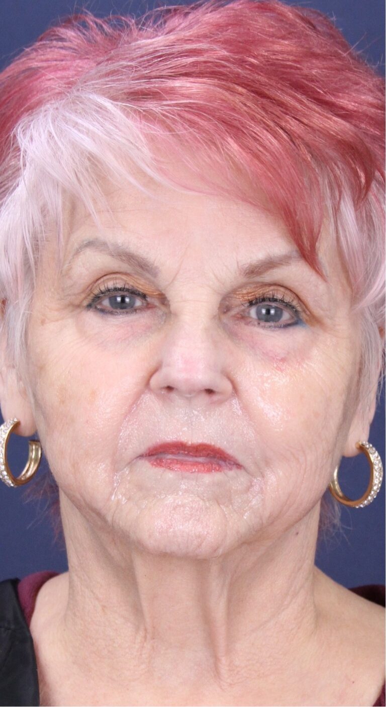 Before Image: Facial Rejuvenation with Radiesse - front