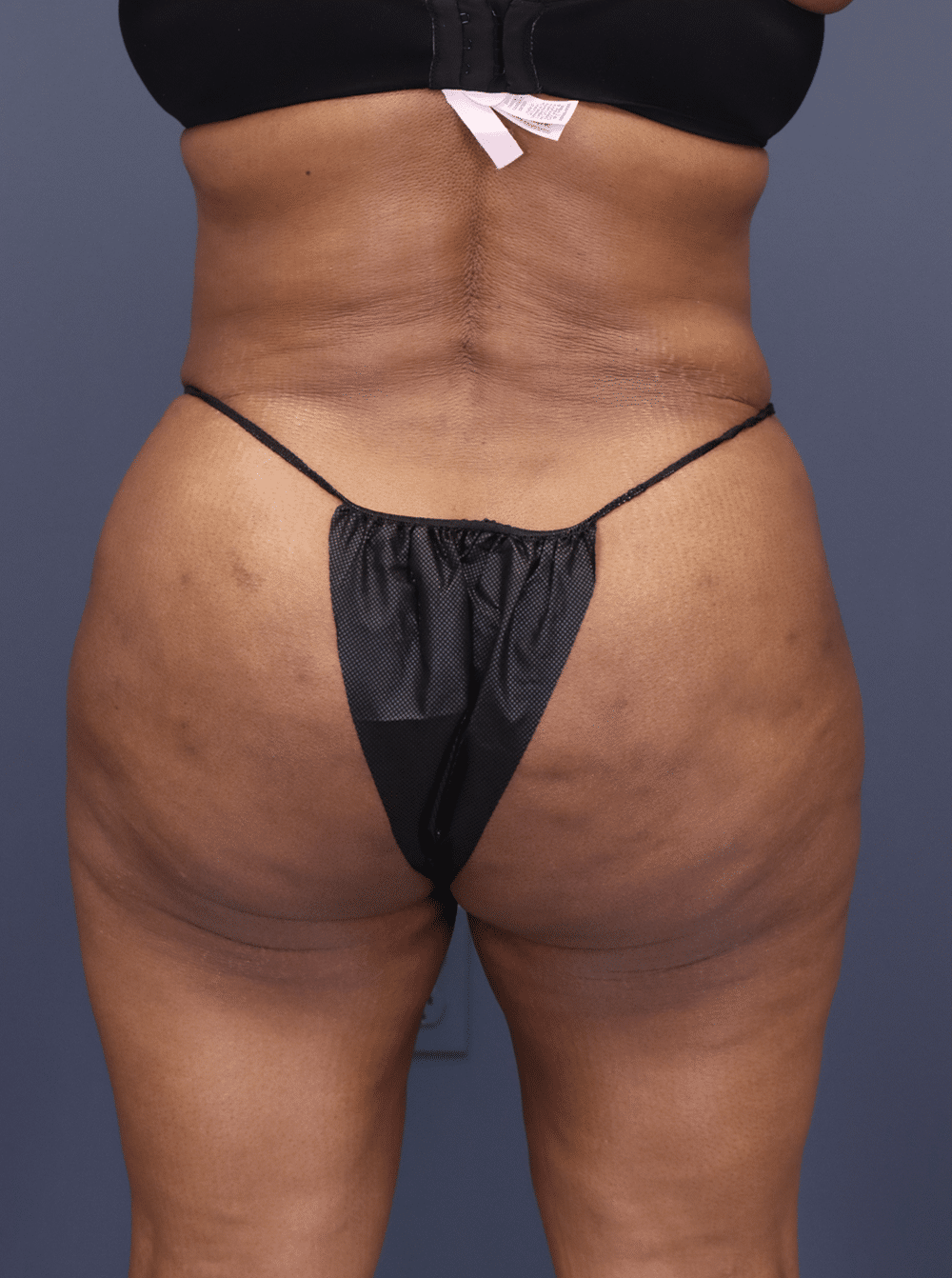 After Image: Injectable Gluteal Augmentation - front