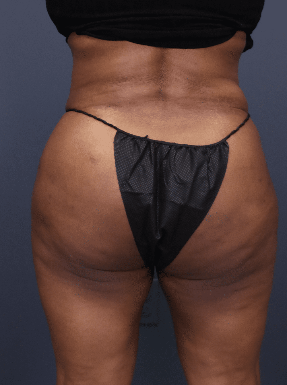 Before Image: Injectable Gluteal Augmentation - front