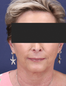 Before Image: Deep plane face lift, neck lift, lower eyelid blepharoplasty, upper blepharoplasty, facial fat grafting, and peri oral deep resurfacing